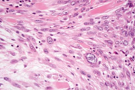 Fig. 35.256, Atypical cellular neurothekeoma: at higher power, note the marked nuclear pleomorphism.