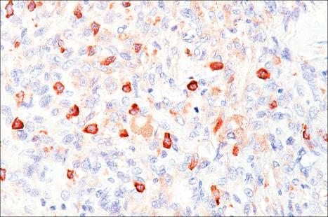 Fig. 35.257, Cellular neurothekeoma: the tumor cells express NKI-C3 but are S100 protein negative.