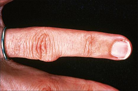 Fig. 35.258, Giant cell tumor of tendon sheath: this lesion presents as a firm nodule that most often affects the finger.