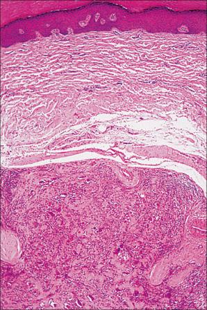 Fig. 35.259, Giant cell tumor of tendon sheath: low-power view showing a sharply circumscribed pseudo-encapsulated tumor.