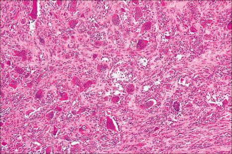 Fig. 35.260, Giant cell tumor of tendon sheath: higher-power view showing xanthoma cells and giant cells.