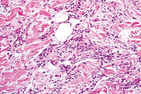 Fig. 35.26, Spindle cell lipoma: high-power view. Note the conspicuous mast cells.