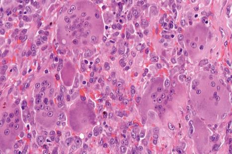 Fig. 35.264, Giant cell tumor of soft tissue: high-power view of osteoclast-like giant cells.