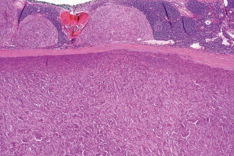 Fig. 35.265, Angiomatoid fibrous histiocytoma: viewed at low power, this condition sometimes resembles a lymph node. Note the multiple tumor nodules and foci of hemorrhage.