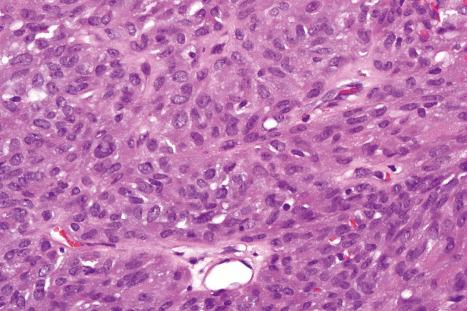 Fig. 35.266, Angiomatoid fibrous histiocytoma: the tumor cells are fairly uniform and have round or oval vesicular nuclei.