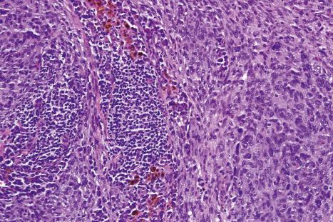 Fig. 35.267, Angiomatoid fibrous histiocytoma: medium-power view highlighting the lymphocytic infiltrate and hemosiderin deposition.