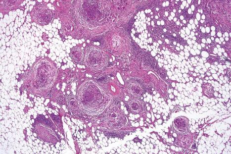 Fig. 35.268, Plexiform fibrous histiocytoma: the prototypical case consists of fibroblastic spindle cell areas in which there are nodules of histiocyte-like cells.