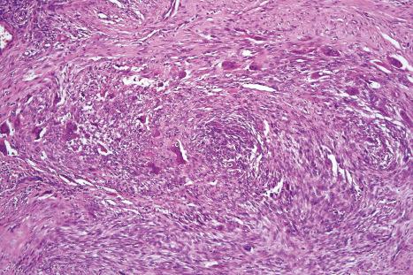 Fig. 35.269, Plexiform fibrous histiocytoma: there are prominent osteoclast-like giant cells.