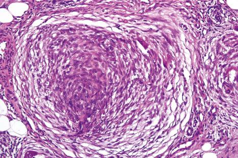 Fig. 35.270, Plexiform fibrous histiocytoma: high-power view of a histiocytic nodule.