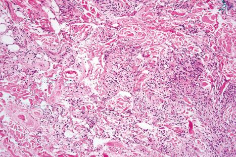 Fig. 35.27, Spindle cell lipoma: in some examples, the spindled cells predominate such that the lesion is easily mistaken for another connective tissue tumor.