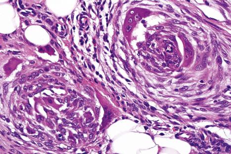 Fig. 35.271, Plexiform fibrous histiocytoma: the histiocyte-like nodules also contain multinucleate (usually osteoclast-like) cells and tend to show stromal hemorrhage.