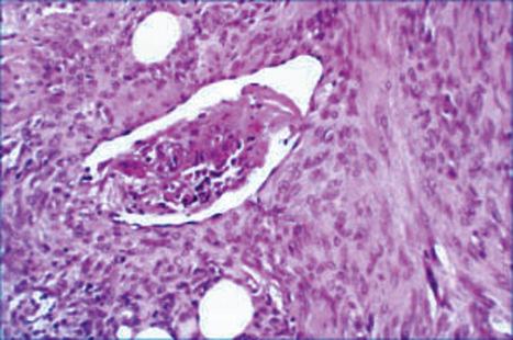 Fig. 35.272, Plexiform fibrous histiocytoma: vascular invasion as seen in this field is an occasional feature. It does not appear to be of prognostic significance.