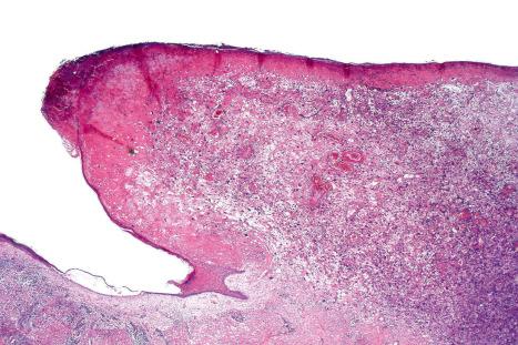 Fig. 35.276, Atypical fibroxanthoma: this low magnification shows an obviously pleomorphic intradermal spindle cell tumor which has eroded the epidermis. Note the lateral collarette.