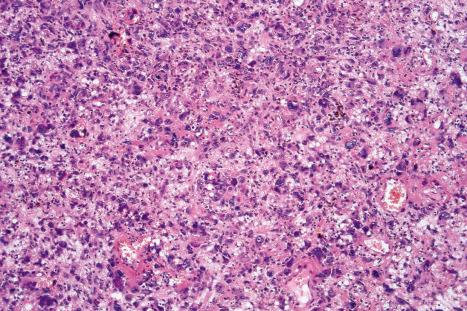 Fig. 35.277, Atypical fibroxanthoma: medium-power view showing a highly cellular and pleomorphic tumor cell infiltrate.