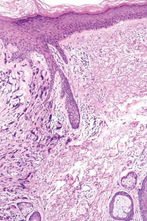 Fig. 35.278, Atypical fibroxanthoma: the adjacent dermis shows gross solar elastosis. There is no epidermal involvement.