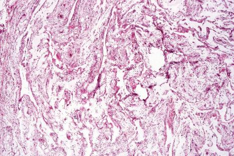 Fig. 35.28, Spindle cell lipoma: rarely, massive myxoid degeneration results in the formation of pseudovascular spaces (the so-called lymphangiomatous variant).