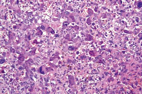 Fig. 35.283, Atypical fibroxanthoma: this is an example of an osteoclast-rich variant.