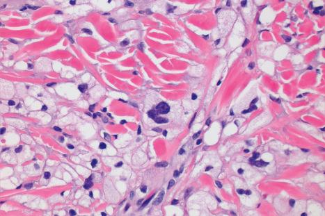 Fig. 35.284, Atypical fibroxanthoma: high-power view of a clear cell variant.