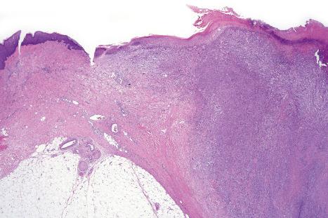 Fig. 35.285, Spindle cell atypical fibroxanthoma: the monomorphic appearance of the spindle cell variant differs considerably from conventional atypical fibroxanthoma.