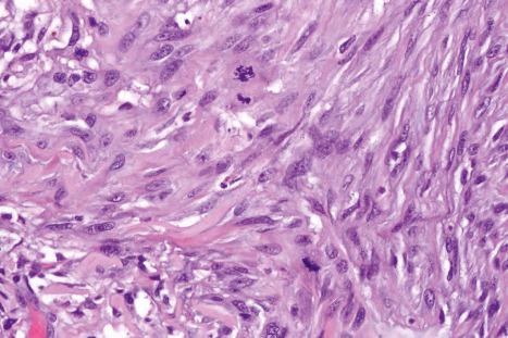 Fig. 35.287, Spindle cell atypical fibroxanthoma: there is brisk mitotic activity.