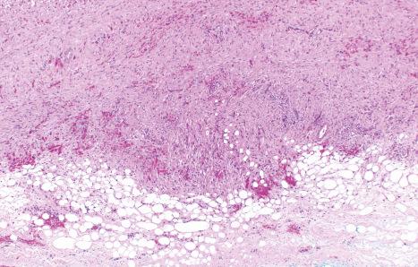 Fig. 35.288, Dermal pleomorphic sarcoma: prominent replacement of the subcutaneous tissue by a pleomorphic tumor.