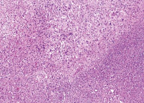 Fig. 35.289, Dermal pleomorphic sarcoma: prominent focal necrosis.