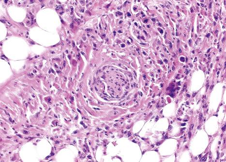 Fig. 35.290, Dermal pleomorphic sarcoma: perineural invasion.