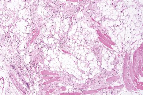 Fig. 35.29, Pleomorphic lipoma: this view shows adipocytes, thick collagen bundles, and spindled cells.