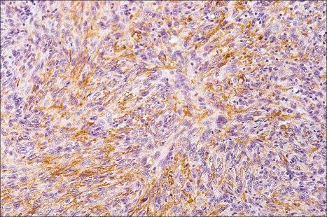 Fig. 35.293, Spindle cell atypical fibroxanthoma: note the diffuse expression of smooth muscle actin.