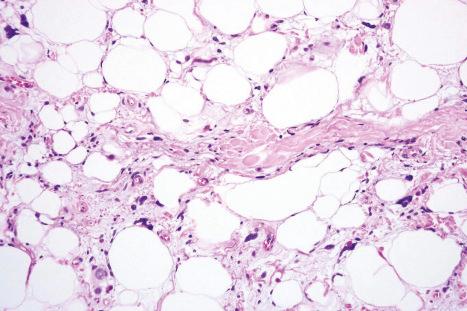 Fig. 35.31, Pleomorphic lipoma: conspicuous floret giant cells are present.