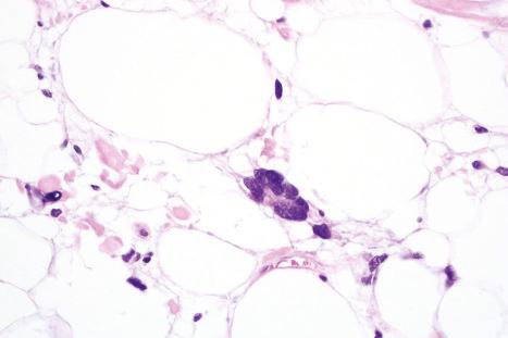 Fig. 35.32, Pleomorphic lipoma: high-power view.