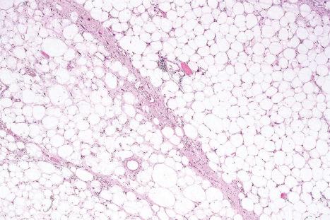 Fig. 35.34, Atypical lipomatous tumor: note the characteristic variation in adipocyte size and the scattered hyperchromatic cells.