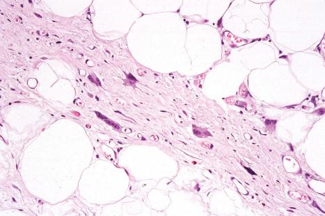 Fig. 35.35, Atypical lipomatous tumor: irregular hyperchromatic stromal cells are typically present, often in proximity to the septa.