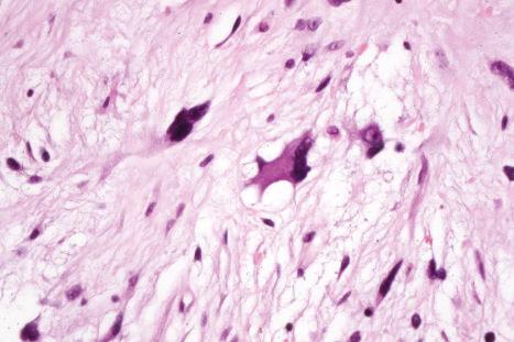 Fig. 35.36, Atypical lipomatous tumor: a multivacuolated lipoblast shown under high power.