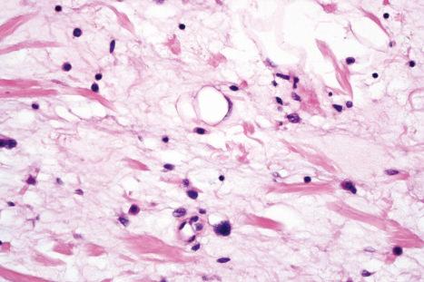 Fig. 35.40, Atypical spindle cell lipomatous tumor: high-power view showing signet-ring cell lipoblasts.