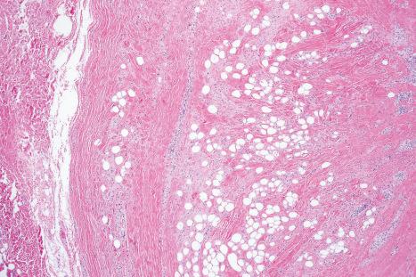 Fig. 35.4, Fibrolipoma: this term is sometimes applied to a lipoma with a prominent fibrous component.