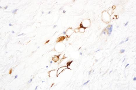 Fig. 35.41, Atypical spindle cell lipomatous tumor: the lipoblasts can be highlighted with S100 protein immunohistochemistry.