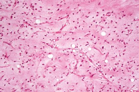 Fig. 35.43, Myxoid liposarcoma: medium-power view showing multiple signet-ring cell lipoblasts and conspicuous capillaries.