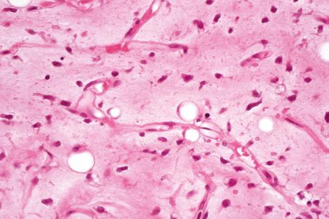 Fig. 35.45, Myxoid liposarcoma: multiple lipoblasts are present.