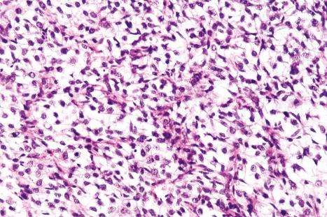 Fig. 35.46, Myxoid liposarcoma: round cell component. In this field, the tumor is much more cellular. The background vasculature is still visible.