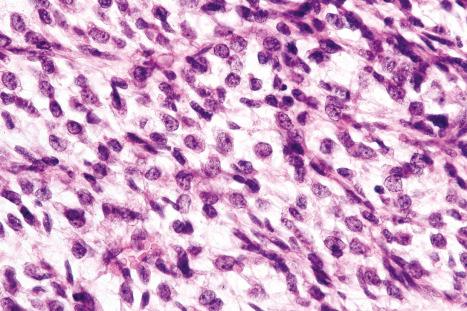 Fig. 35.47, Myxoid liposarcoma: round cell component. The nuclei are hyperchromatic and pleomorphic.