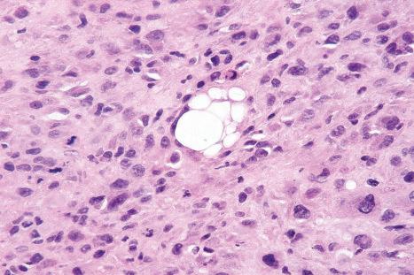 Fig. 35.48, Pleomorphic liposarcoma: recognition of this variant is dependent upon identification of lipoblasts among the highly pleomorphic cellular background.