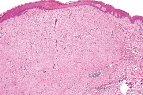 Fig. 35.50, Hypertrophic scar: the lesion is composed of banal fibroblasts with a variably collagenous stroma.