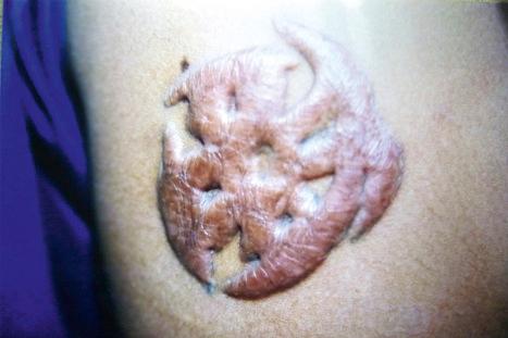 Fig. 35.52, Prominent keloid developing at the side of a tattoo.