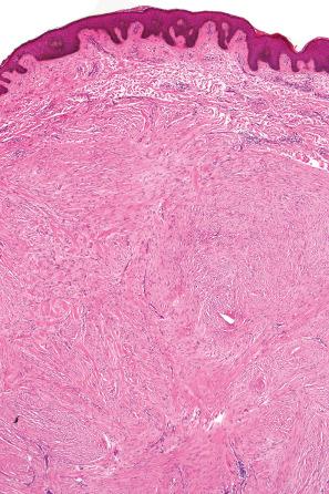 Fig. 35.55, Keloid: this lesion is distinguished from a hypertrophic scar by the presence of broad bundles of eosinophilic, hyalinized collagen.