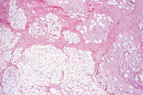 Fig. 35.6, Myxofibrolipoma: this variant of lipoma is characterized by fibrosis and foci of myxoid change. It is of no clinical significance.