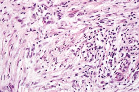 Fig. 35.62, Nodular fasciitis: small numbers of lymphocytes are usually evident.