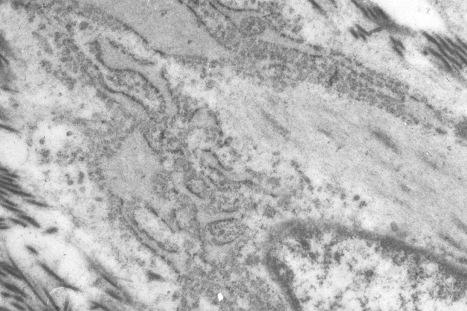 Fig. 35.65, Nodular fasciitis: ultrastructurally, the spindled cells show features of myofibroblasts. Note the conspicuous rough endoplasmic reticulum and filaments with dense bodies.