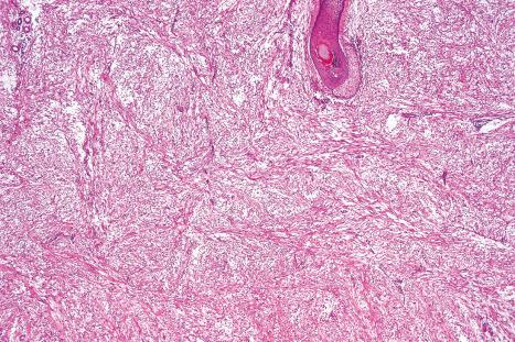 Fig. 35.66, Dermal fasciitis: low-power view showing a myxoid dermal spindled cell proliferation.