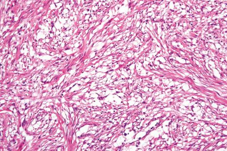 Fig. 35.67, Dermal fasciitis: the spindled cells have uniform vesicular nuclei with small nucleoli.